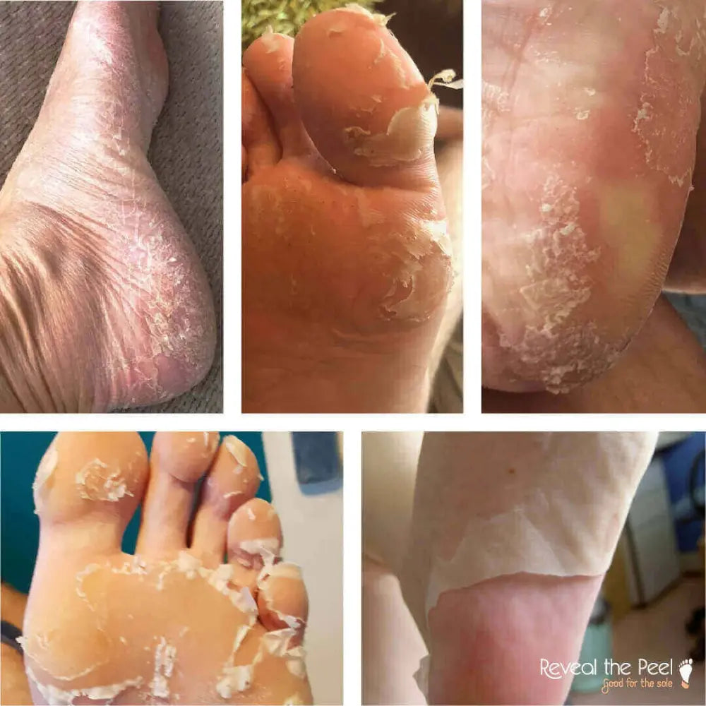 Reveal the Peel - Intense Exfoliating Foot Peel Mask