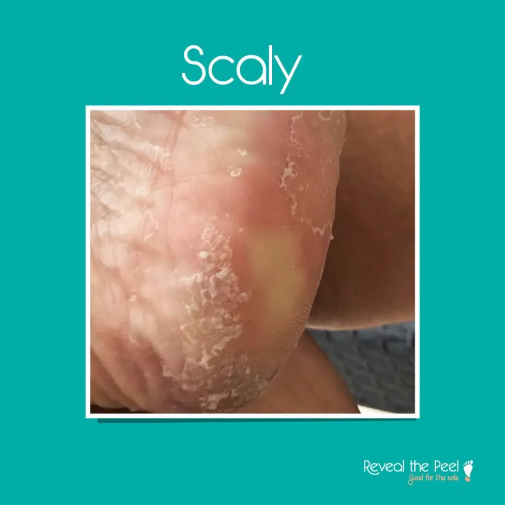 Reveal the Peel - Intense Exfoliating Foot Peel Mask